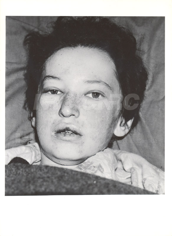 Lupus Erythematosis 1949-1951 001